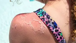 Napégés utáni bőrápolás