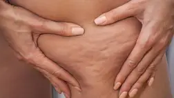 Mindenki ezzel akarja eltüntetni a narancsbőrt, pedig hatástalan