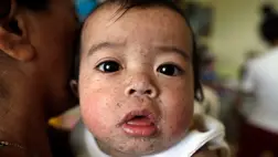 Kanyaróval fertőzött Fülöp-szigeteki gyermek egy manilai közkórházban (Fotó: MTI/EPA/Francis R. Malasig)