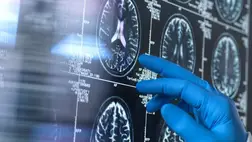 Azonosíthatták a fiatalkori demencia kiváltó okait 