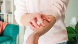 8 étel, ami berobbantja az ekcémát – A többségét naponta esszük