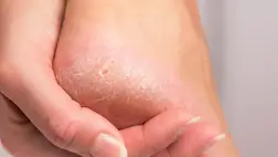 Eltűnik a makacs bőrkeményedés, puha lesz a láb