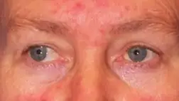 Kipirosodott az orra a tavaszi naptól? Ha rozácea, fontos a kezelés! 