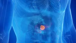 Kitálaltak a tudósok: ez a rejtett tényező teszi igazán halálossá a hasnyálmirigyrákot