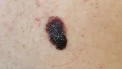 Megváltoztathatja a napfény az anyajegyet? 