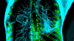 Nem csak a cigaretta növeli drámaian a tüdőrák esélyét