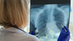 A tuberkulózist még ma sem sikerült legyőzni!