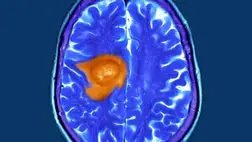 Megvan a vitamin, ami legyőzheti a leghalálosabb agydaganatot