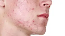 Mindent próbált, de nem múlnak a pattanások? A bőratkakezelés segíthet