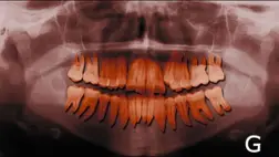 Itt a meglepő válasz: miért nem számítanak a fogak csontnak