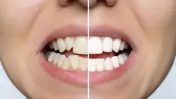 Otthoni megoldások fogfehérítésre – mi az, ami tényleg működik?