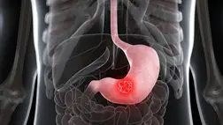 A gyomorrák 5 korai tünete: gyakran ártalmatlannak tűnő emésztési panaszokra hasonlítanak