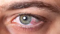 Végleges látásvesztést okozhat ez az ártalmatlannak hitt tünet