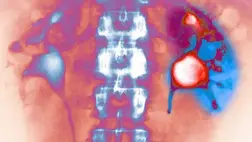 A több víz ivása sem óv meg a vesekő kiújulásától