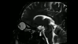 Ezért ne dörzsöljük a szemünket