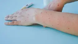 Majomhimlő - Megfertőződött egy gyermek Németországban