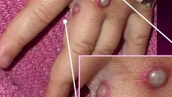 Majomhimlő - Romániában is diagnosztizálták az első esetet