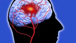 Stroke: ez a vércsoport van a legnagyobb veszélyben