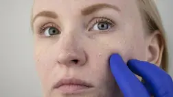 8 intő jel a bőrön, ami D-vitamin hiányra utal tél végén