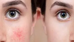 5 bevált külső és belső módszer rosacea ellen: elmondjuk azt is, mi árt ilyenkor