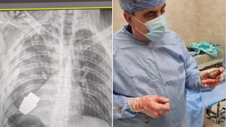 Fel nem robbant gránátot műtöttek ki egy katonából az ukrán katonai orvosok. (Fotó: Facebook bejegyzés)