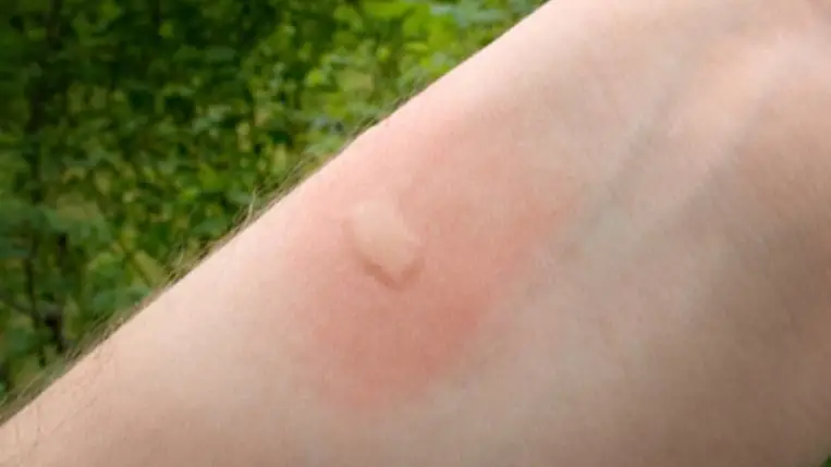 Darázscsípés. Illusztráció. Fotó: internet