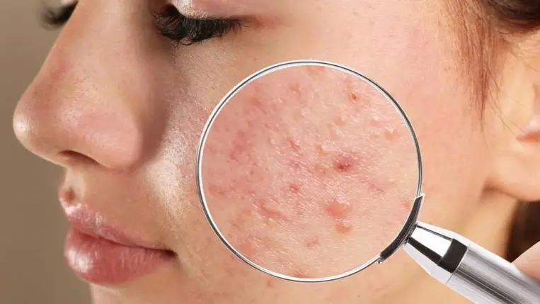Egy új molekula alapjaiban változtathatja meg a pattanások kezelését