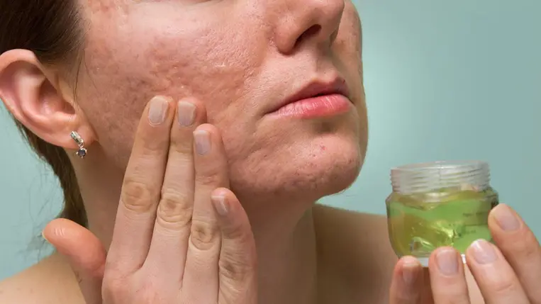 10 házi módszer, amivel megszabadulhatsz a hegektől az arcodon