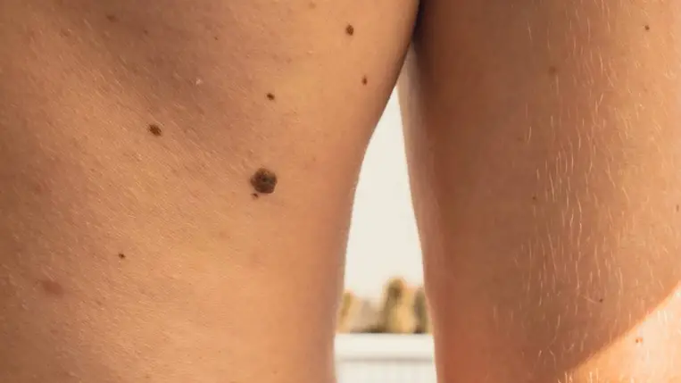 2040-re megduplázódhat a bőrrákos megbetegedések száma a WHO szerint