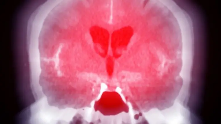 Szunnyadó kórokozót ébreszthet fel a fejsérülés 