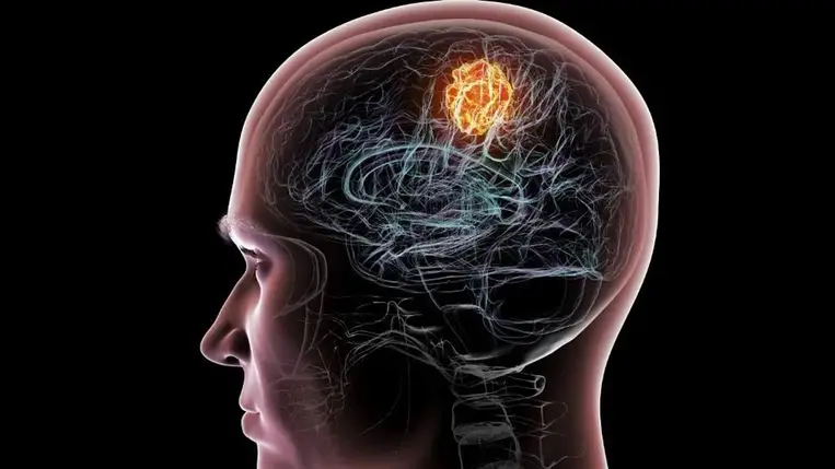Csendes vészjelzések: az agydaganat hét korai jele