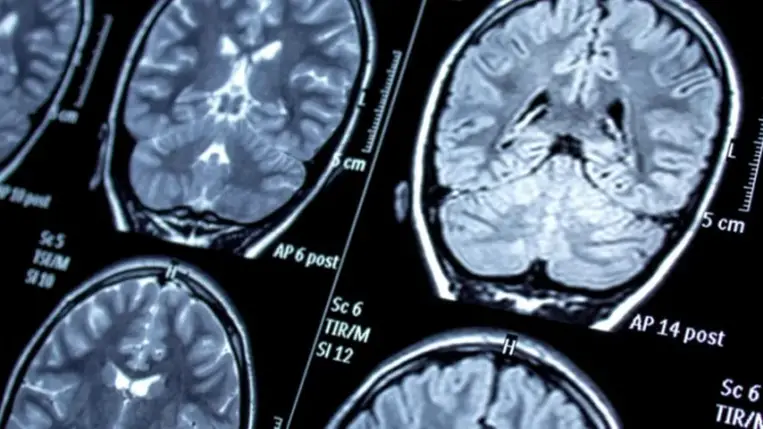 Hogyan hat az időjárás, az időjárási frontok az epilepsziára? 