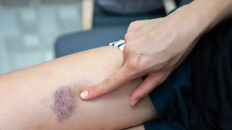 K-vitamin hiány: 4 tünet, amiből rájöhetsz