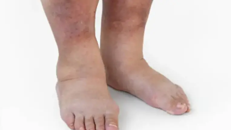 A meleg fokozza a vérrögképződés kockázatát – kik a veszélyeztetettek? 