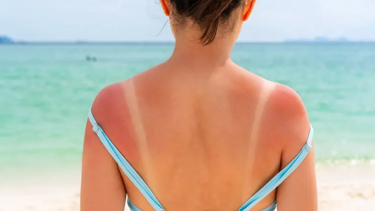 Napégés utáni bőrápolás