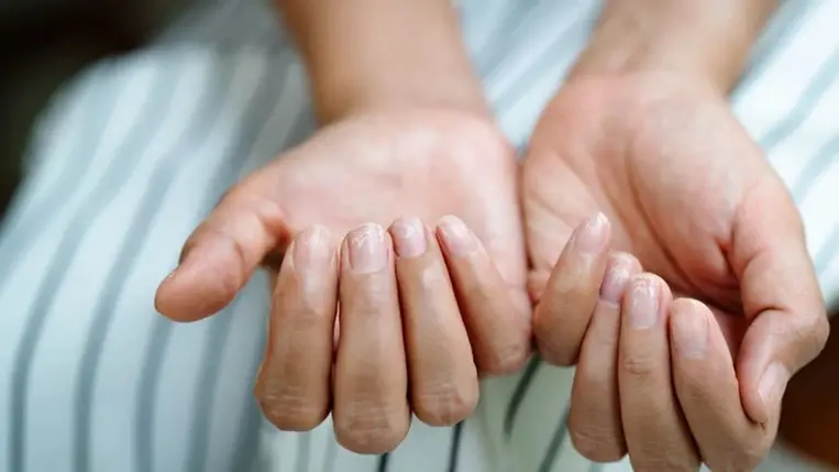 Ez a 7 jel a körmödön komoly betegséget jelezhet