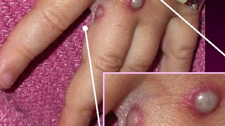 Majomhimlő - Romániában is diagnosztizálták az első esetet