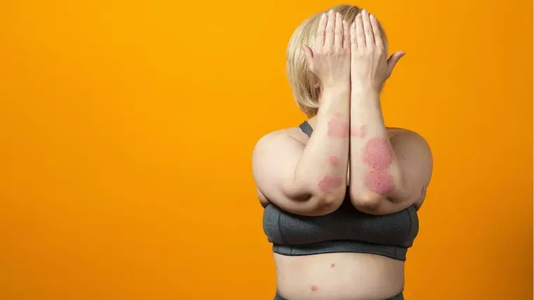 Összefüggés figyelhető meg a pikkelysömörös tünetek és az étrend között 