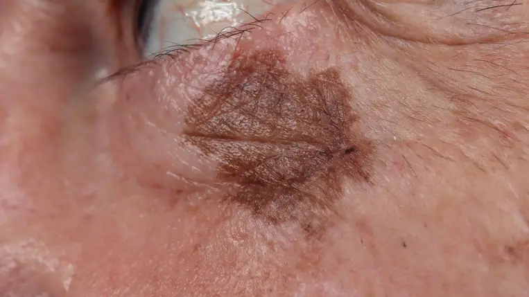 Megelőzés helyett gyorsíthatják a halálos ráktípus terjedését az antioxidánsok 