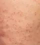 Sima láb helyett apró pöttyök? Így kezelhető az eperláb