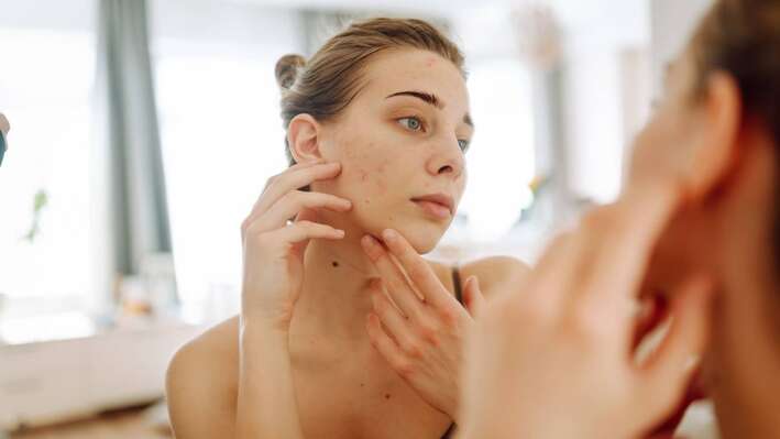 9 bőrtünet, amiről nem gondolnád, hogy emésztési probléma okozza